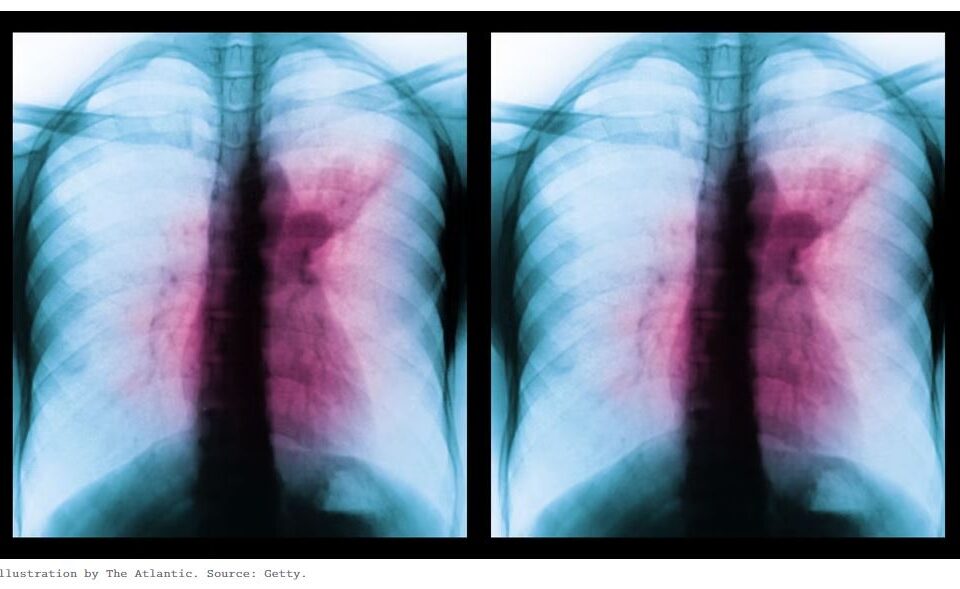 Kari unveils cheaper lung plague vaccine